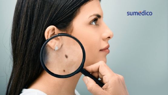 Las señales de cáncer de piel que NO debes ignorar