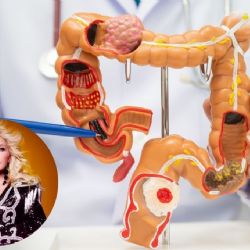 ¿Qué es el cáncer de intestino que padeció Yuri?