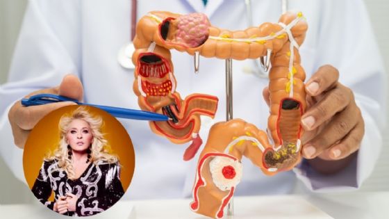 ¿Qué es el cáncer de intestino que padeció Yuri?