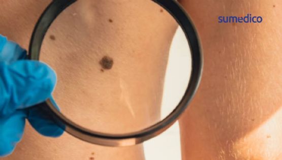 FDA aprueba nueva terapia para cáncer de piel avanzado tras dos rechazos